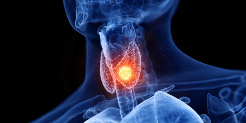3d rendered medically accurate illustration of thyroid cancer